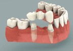 Мостовидные зубные протезы в Германии