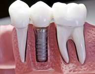 Обследование перед имплантацией зубов в Германии
