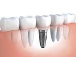 Осложнения имплантации зубов